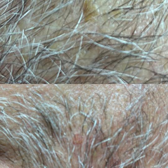 Belle Ana #beograd Tretman lica Phi-Ion tretman - bradavice / papilomi / keratoze / milije / hiperpi