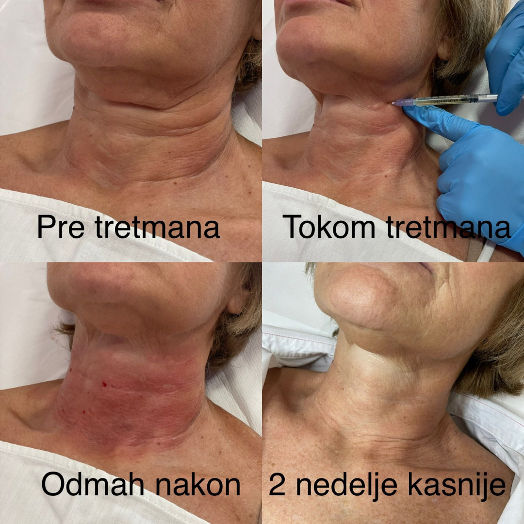 Poliklinika Marić #novisad Tretman lica Cellular Matrix - PRP lica + vrata + dekoltea sa hijaluronom