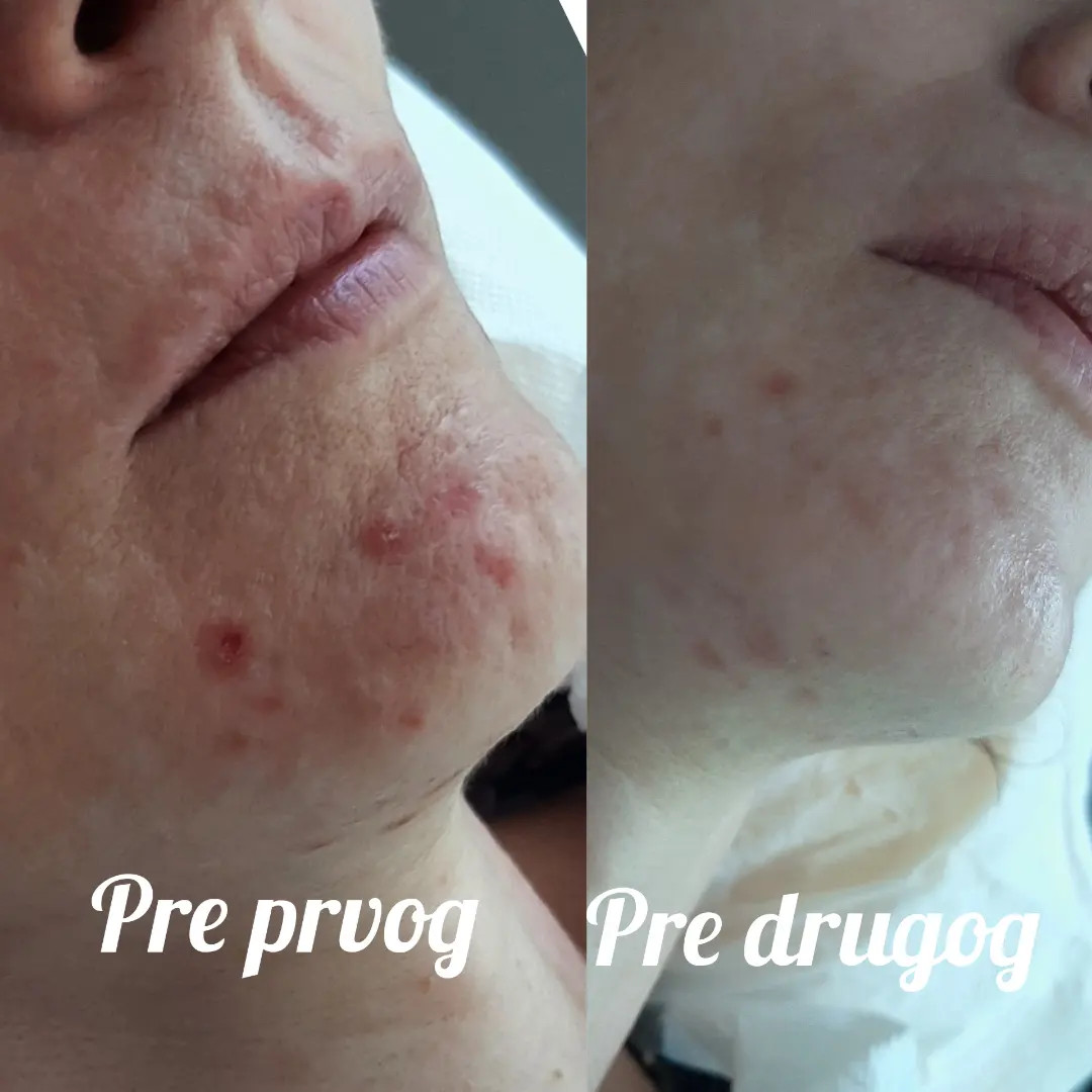 Elin Sary Mary Kutak #beograd Medicinski pedikir Derma Fix tretman lica sa kolagenskim nitima