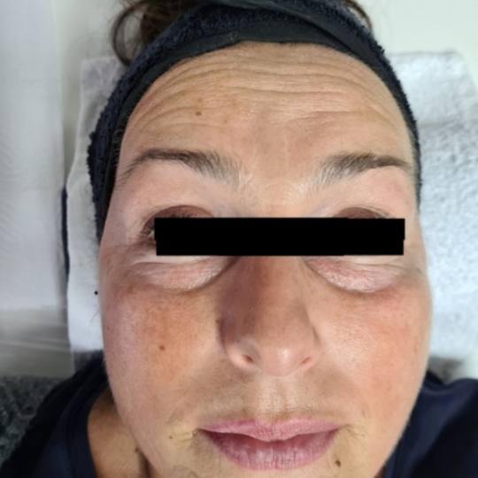 SunBox #beograd Masaža lica Face gym / Face fitness - anti age masaža lica