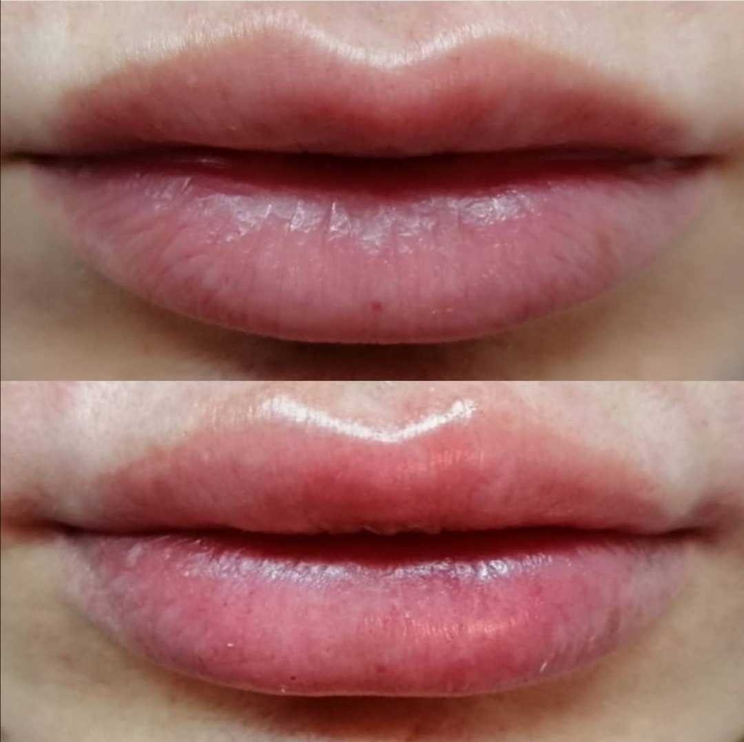 Ordinacija Dr Bojana Banjanin #beograd Dermalni fileri