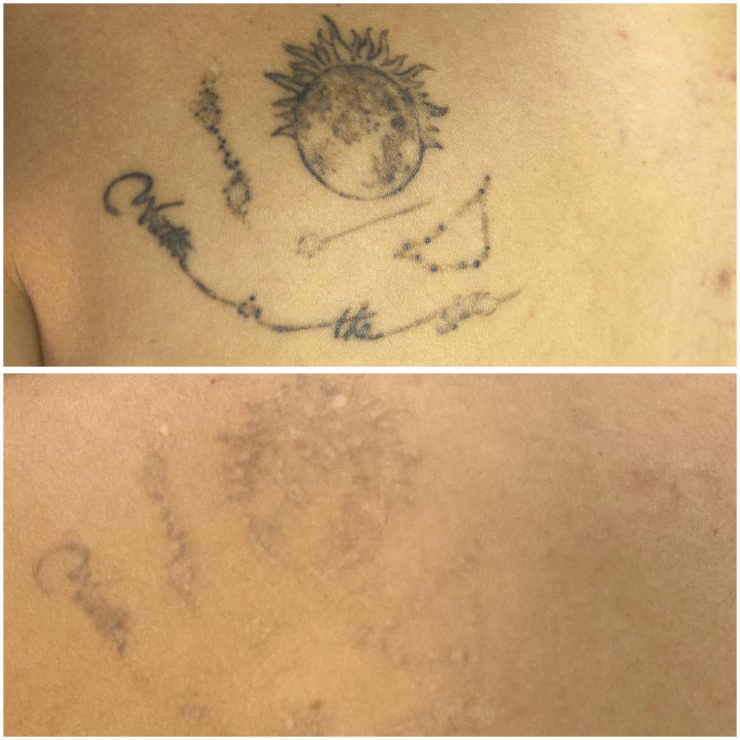 Lasersko uklanjanje tetovaže - Belle Ana, Beograd Uklanjanje tetovaža Telo Uklanjanje tetovaža, Beograd, Vračar, Čubura, Crveni krst