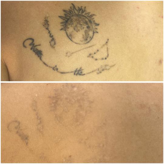 Belle Ana #beograd Uklanjanje tetovaža Lasersko uklanjanje tetovaže