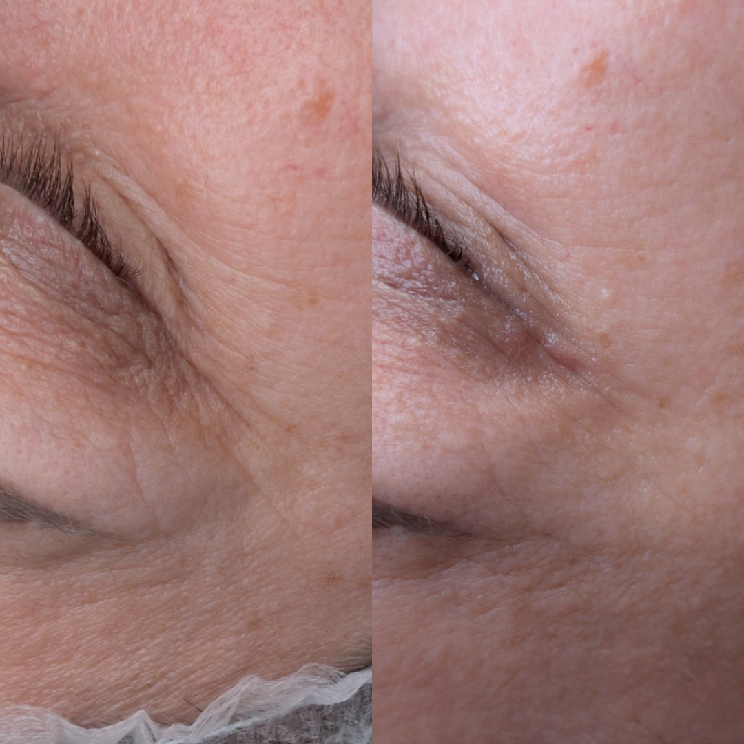 Brow & Glow #novisad Tretman lica Mezoporacija lica