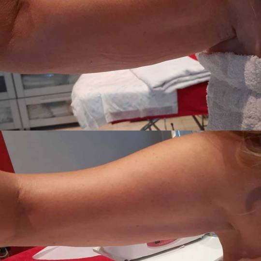Grossi cosmetic #beograd Radiotalasni lifting