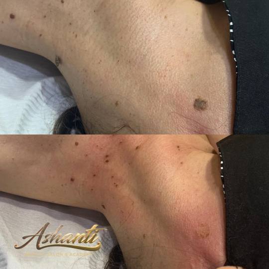 Ashanti Beauty Salon & Academy #beograd Tretman lica Plasma pen - skidanje do 10 bradavica