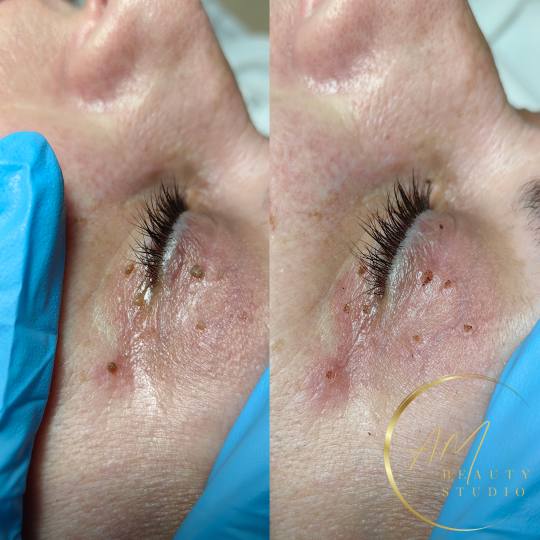 AM BEAUTY STUDIO #odzaci Tretman lica Uklanjanje papiloma