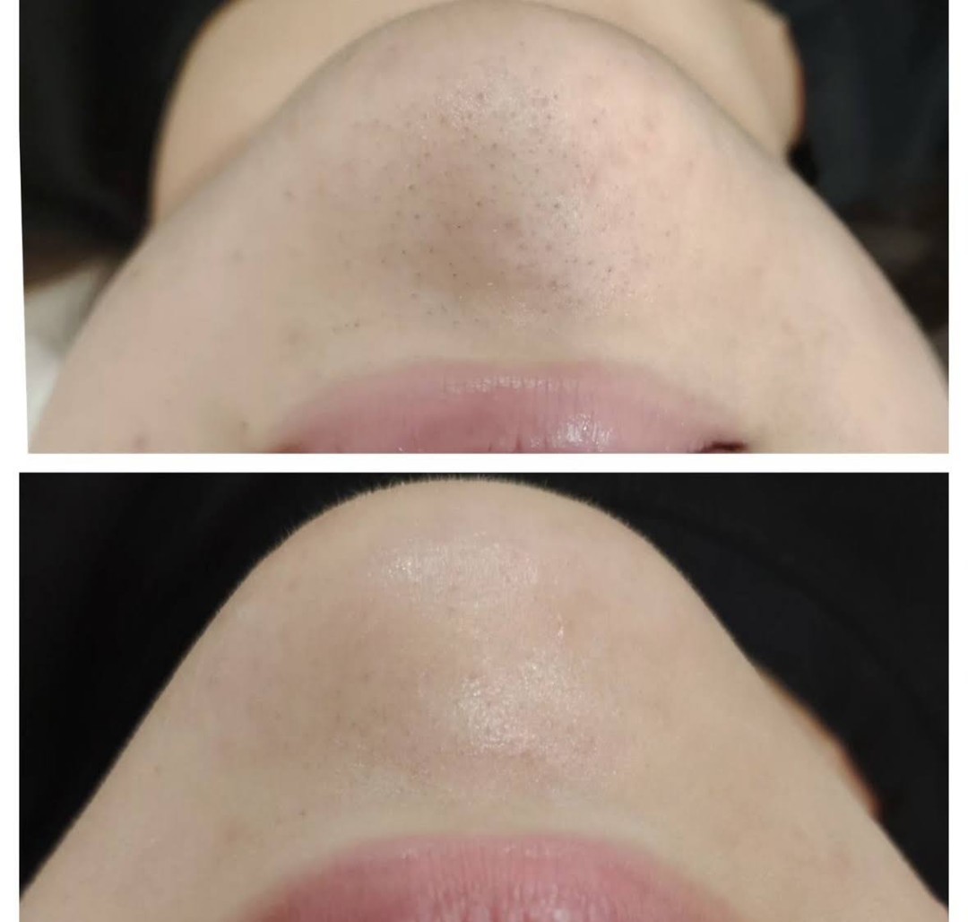 MediBella Aesthetic Dedinje #beograd Tretman lica Hydrafacial - tretman lica