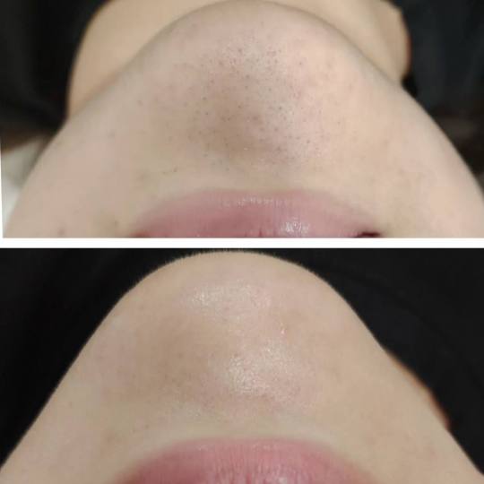 MediBella Aesthetic Dedinje #beograd Tretman lica Hydrafacial - tretman lica Hydrafacial tretman je 