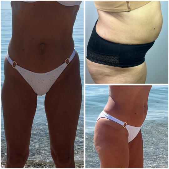 Belle Ana #beograd Tretmani tela EMS tretman - 2 regije