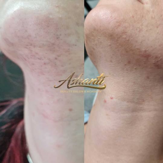 Ashanti Beauty Salon & Academy #beograd Laserska epilacija Laserska epilacija brade + podbrade Rezul