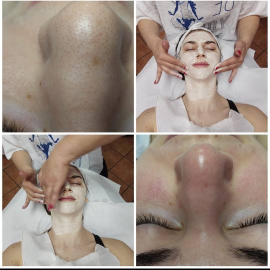 Biljana #novisad Hijaluronski tretmani lica Osnovni tretman lica