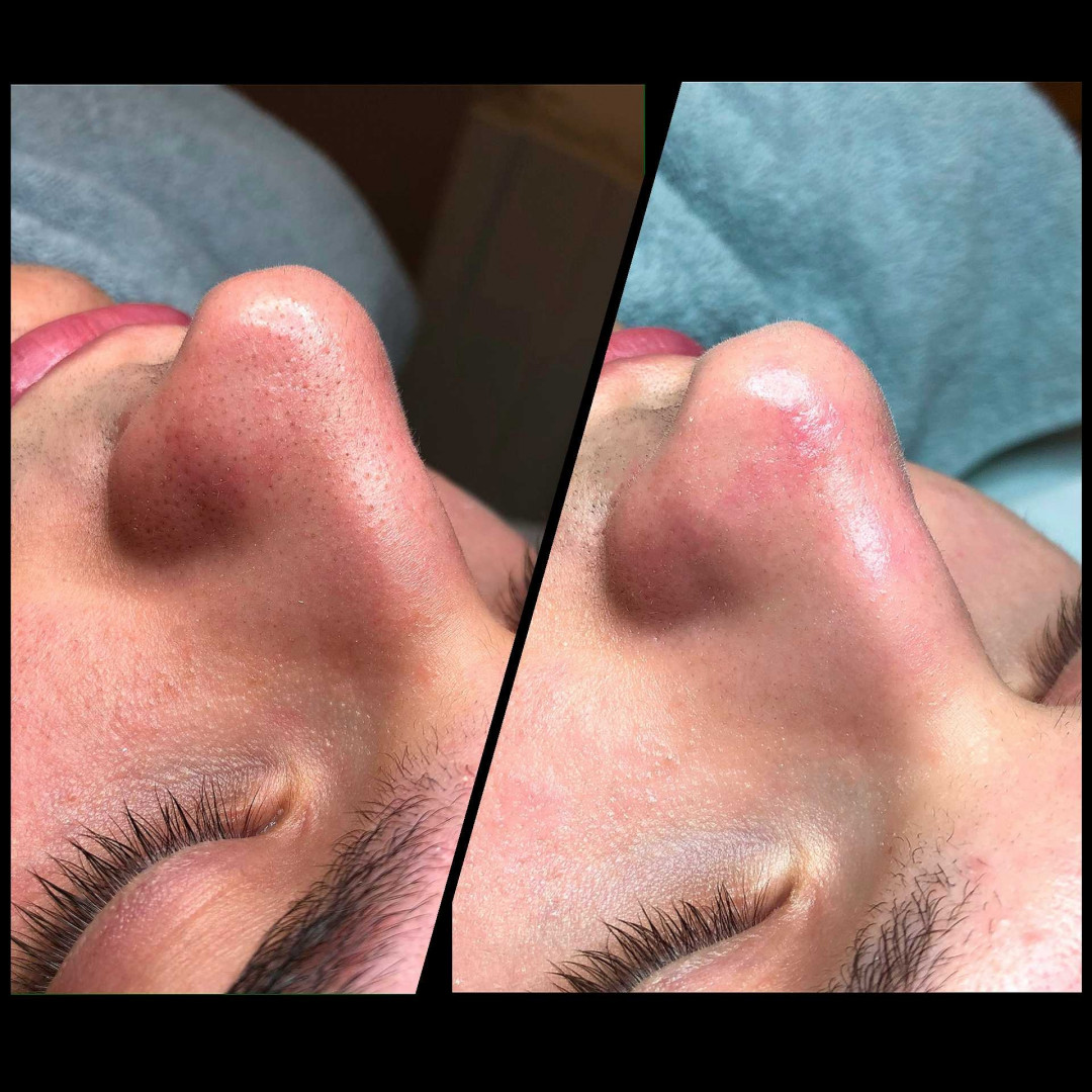 Skin Expert Aesthetic & Laser centar #beograd Tretman lica Higijenski tretman lica