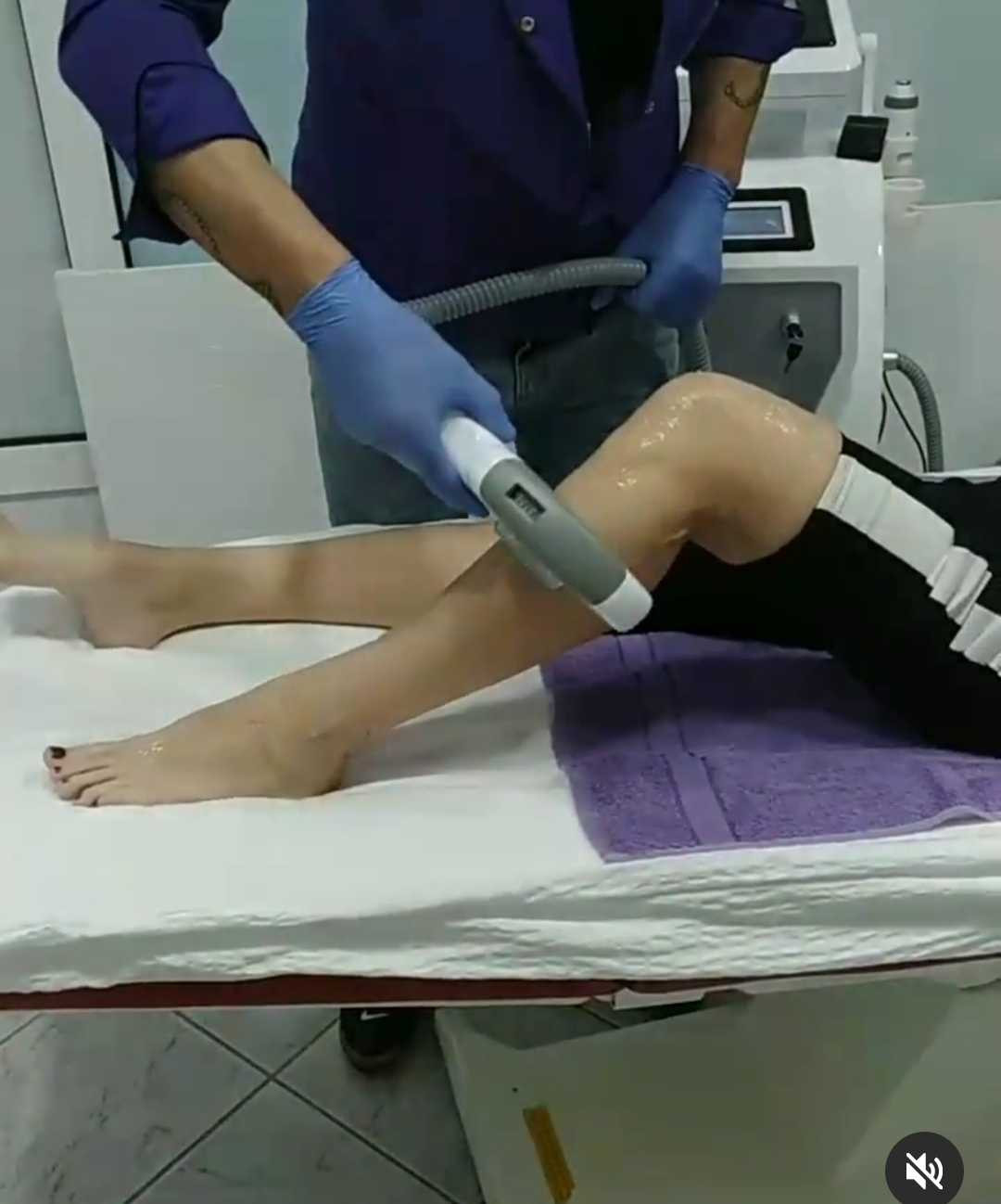 AltaBella Batajnica #beograd Laserska epilacija Laserska epilacija potkolenica - za dame