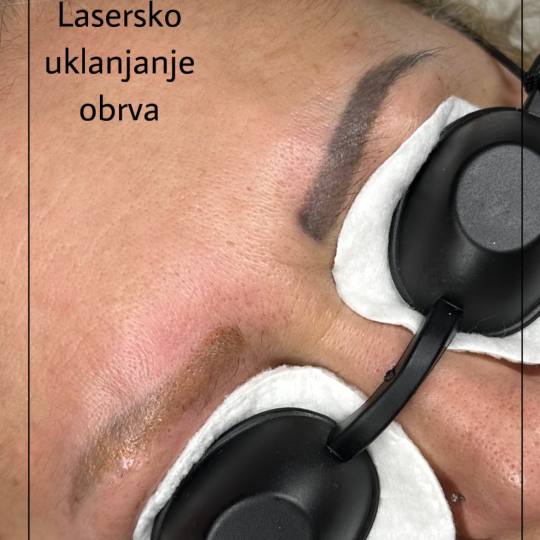 Kult #beograd Laserski tretmani lica Lasersko uklanjanje obrva