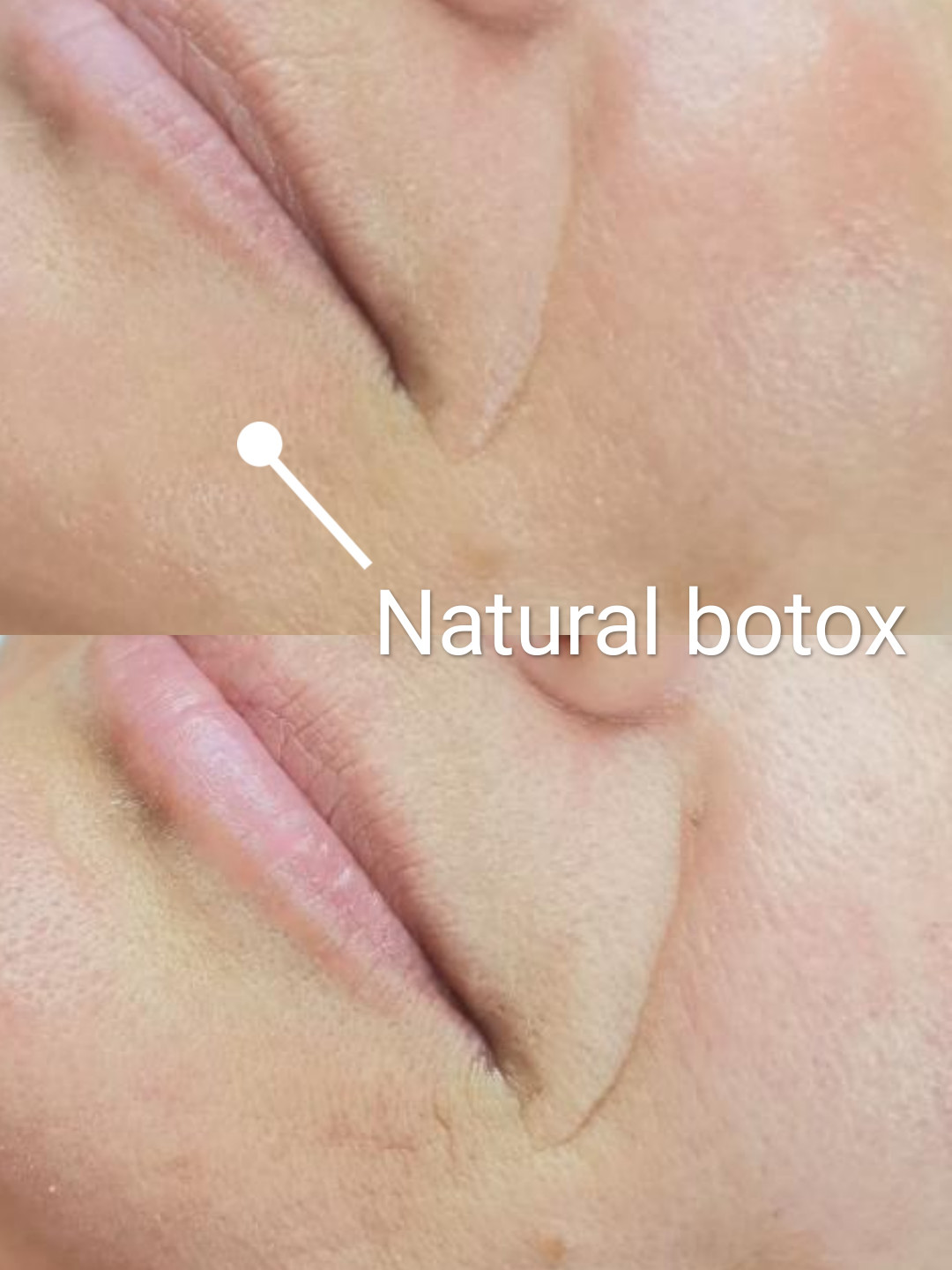 Contessa #novisad Tretman lica Natural botox