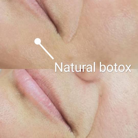 Contessa #novisad Tretman lica Natural botox
