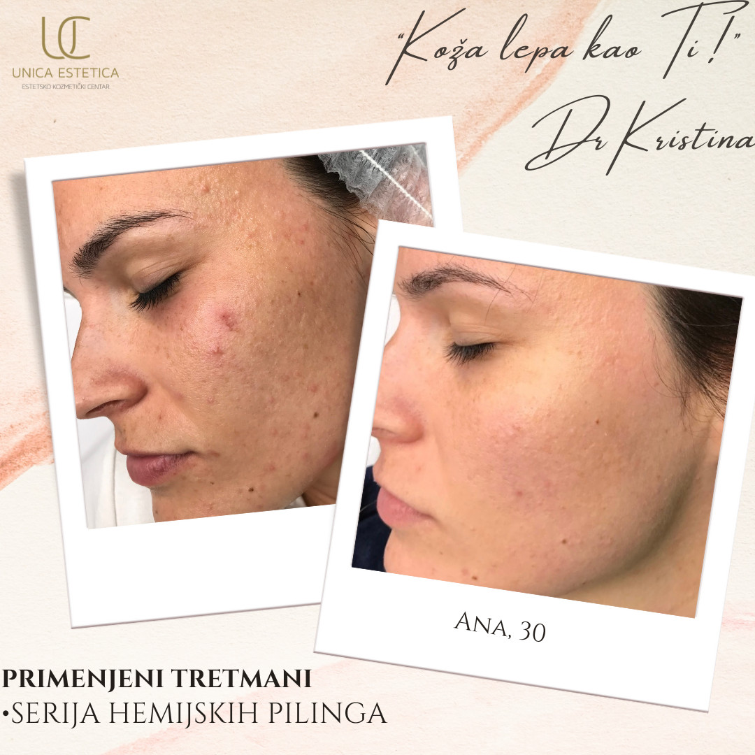 Unica Estetica #nis Tretman lica Lightening