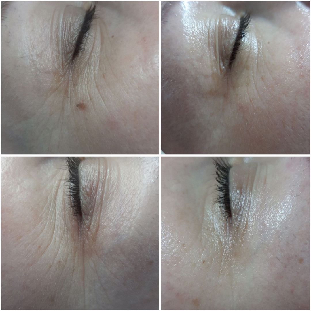 Look at me #beograd Tretman lica Eyelid booster