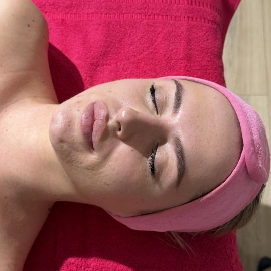 Lola esthetic center #beograd Tretman lica Hydradermie - aparaturni personalizovani tretman lica za 