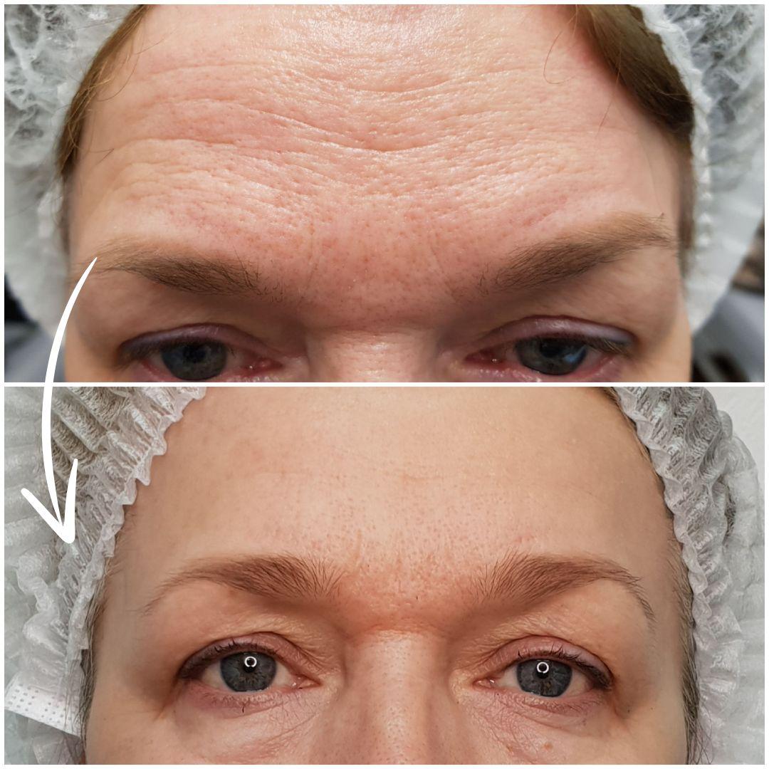 Angelique signature lift - Angelique beauty center, Beograd Lifting / zatezanje kože Lice Lifting / zatezanje kože, Beograd, Žarkovo, Cerak, Bele vode