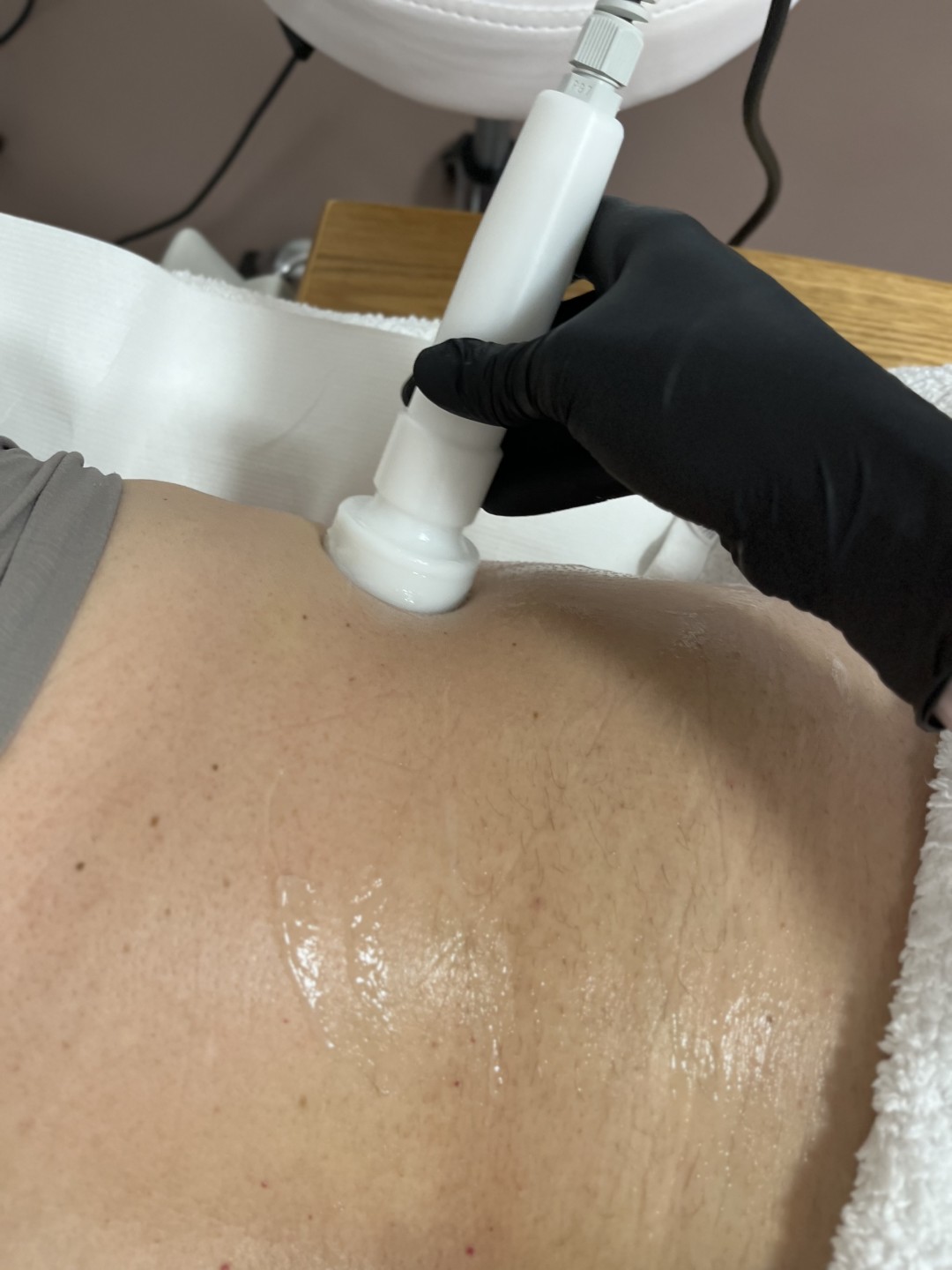 Victoria Aesthetics #beograd Tretmani tela Lipoliza lokalizovanih masnih naslaga mezoporacijom - po regijama