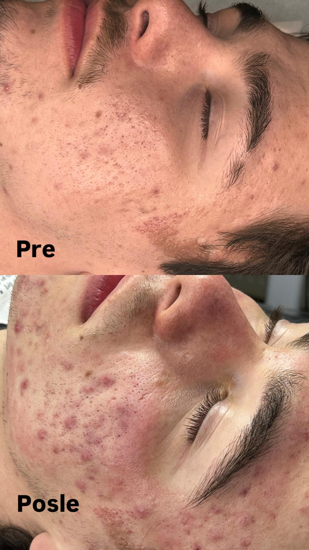 Belle Ana #beograd Tretman lica Microneedling tretman - lice