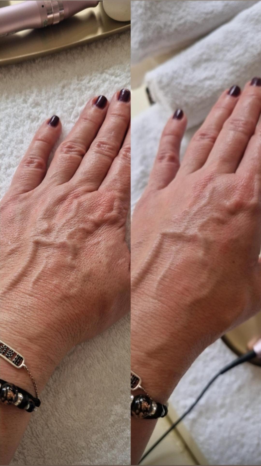 Dermapen microneedling šaka 45 min - Glow Holistic Studio, Beograd Tretman lica Lice Tretman lica, Beograd, Novi Beograd blokovi, Belville, Savski kej