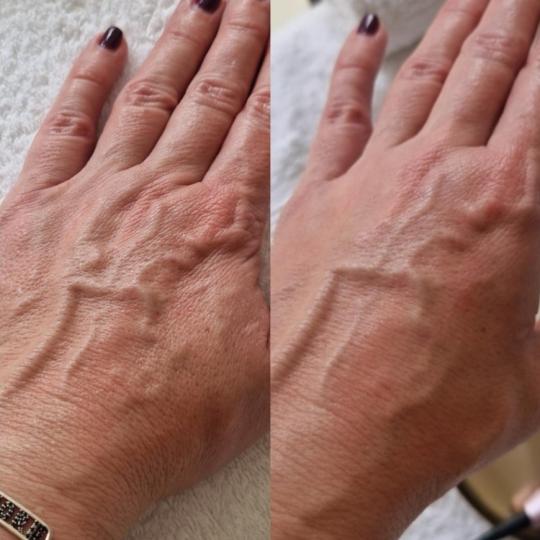 Glow Holistic Studio #beograd Tretman lica Dermapen microneedling šaka 45 min Dermapen microneedlin