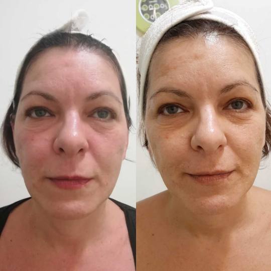 Olja Beauty #beograd Lifting / zatezanje kože HiFu tretman lica - po regiji