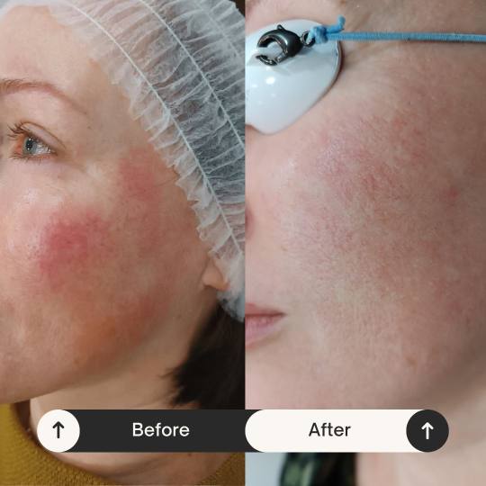 MediBella Aesthetic Dedinje #beograd Laserski tretmani lica Lasersko lečenje rozacee Rozacea je hro