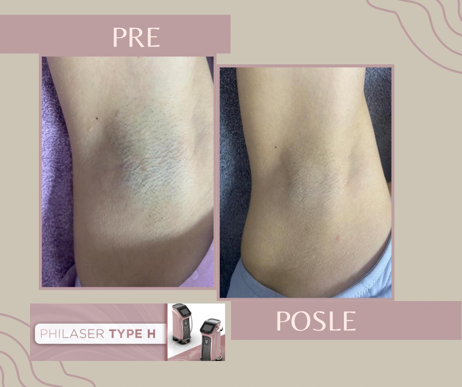 Beauty by Nevena Panić #beograd Laserska epilacija Laserska epilacija pazuha - za dame