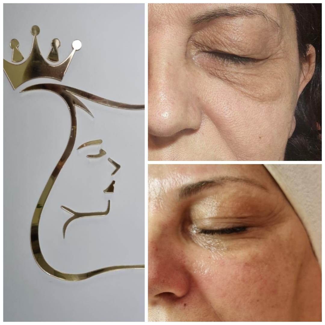 Emilly #beograd Tretman lica Skin boosters tretman lica