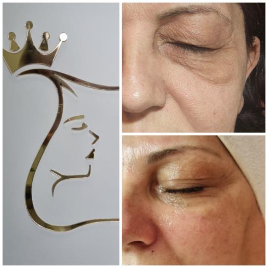 Emilly #beograd Tretman lica Skin boosters tretman lica Tretman koji daje vidne rezultate, zategnutu