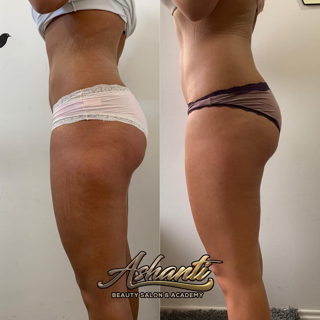 Ashanti Beauty Salon & Academy #beograd Masaža za mršavljenje Vacuslim 48 / Vacuumfit - stomak + bokovi + noge - paket od 5 tretmana