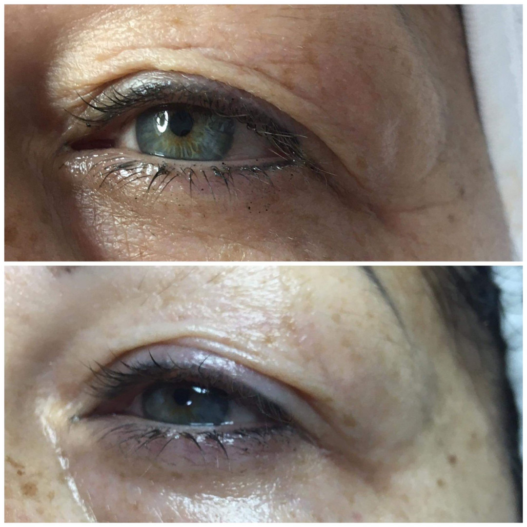 Look at me #beograd Tretman lica Eyelid booster