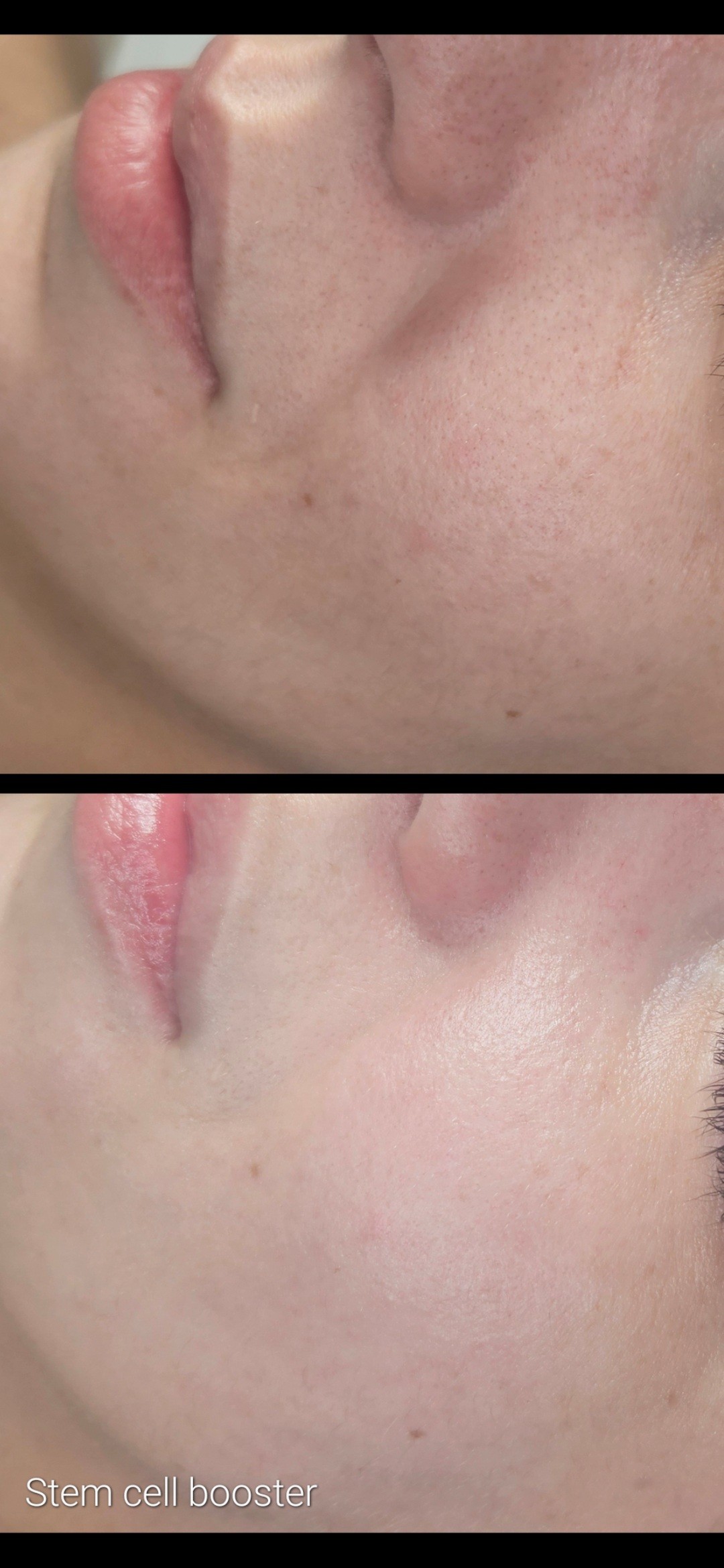Beauty salon XL Lady #beograd Tretman lica Enzimski piling - Stem cell booster