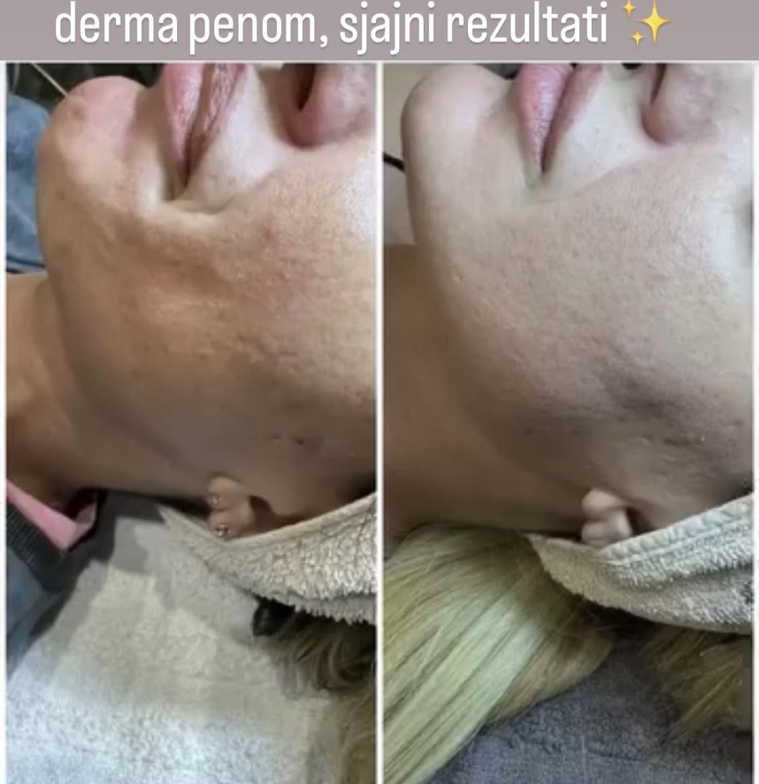 Dermapen tretman lica - Petra beauty concept, Beograd Dermaroler i dermapen Lice Dermaroler i dermapen, Beograd, Vračar, Čubura, Crveni krst