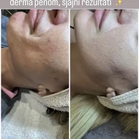 Petra beauty concept #beograd Dermaroler i dermapen Dermapen tretman lica