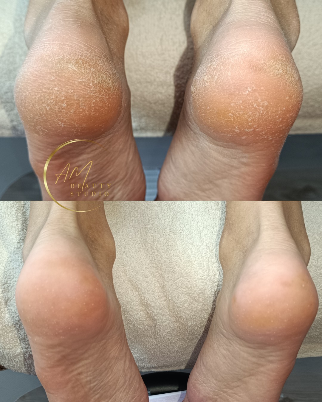 AM BEAUTY STUDIO #odzaci Tretmani tela Aparatni pedikir