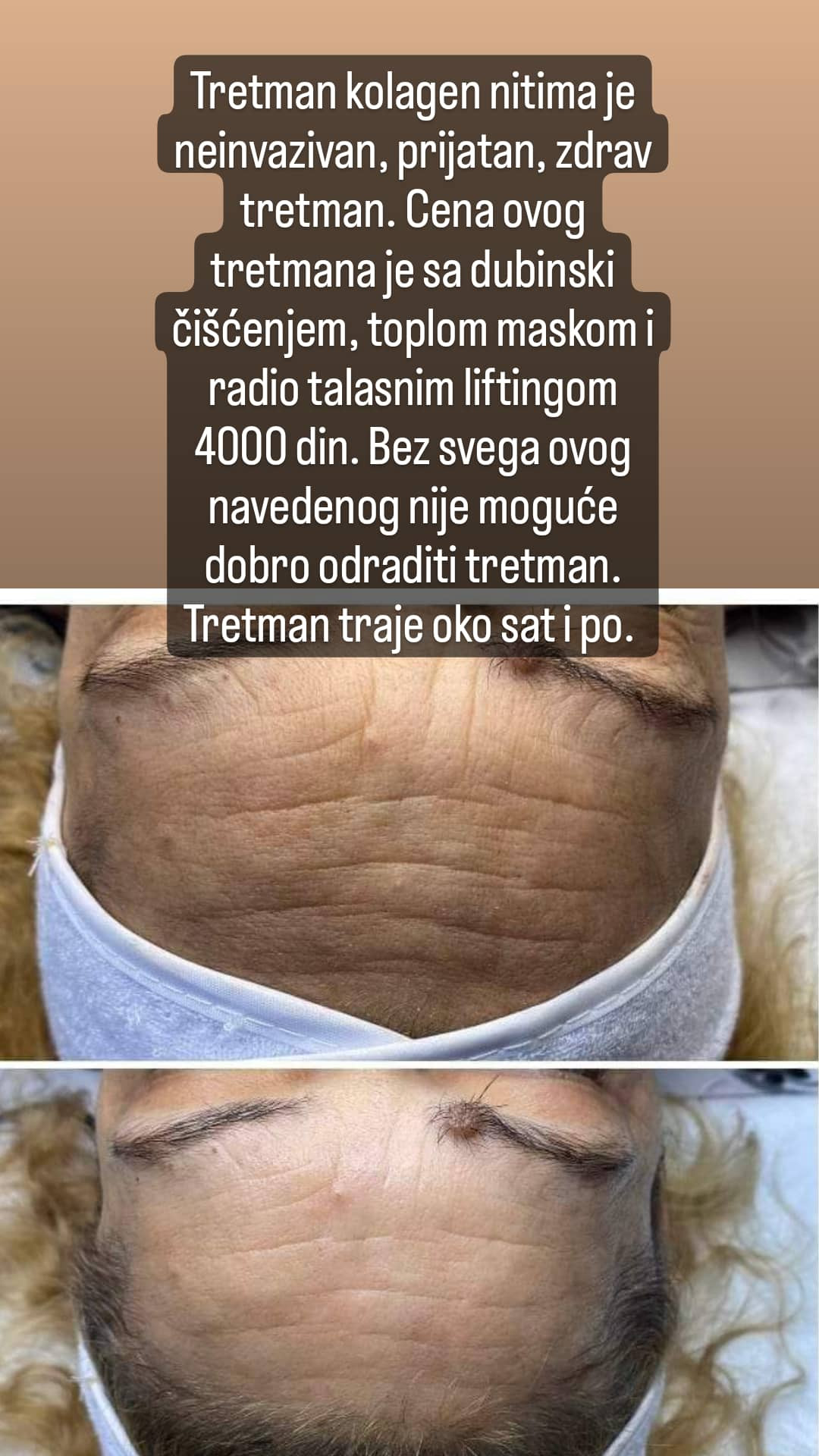 Kolagen niti - lice - Ceragem Relax, Kruševac Tretman lica Lice Tretman lica, Kruševac, Centar