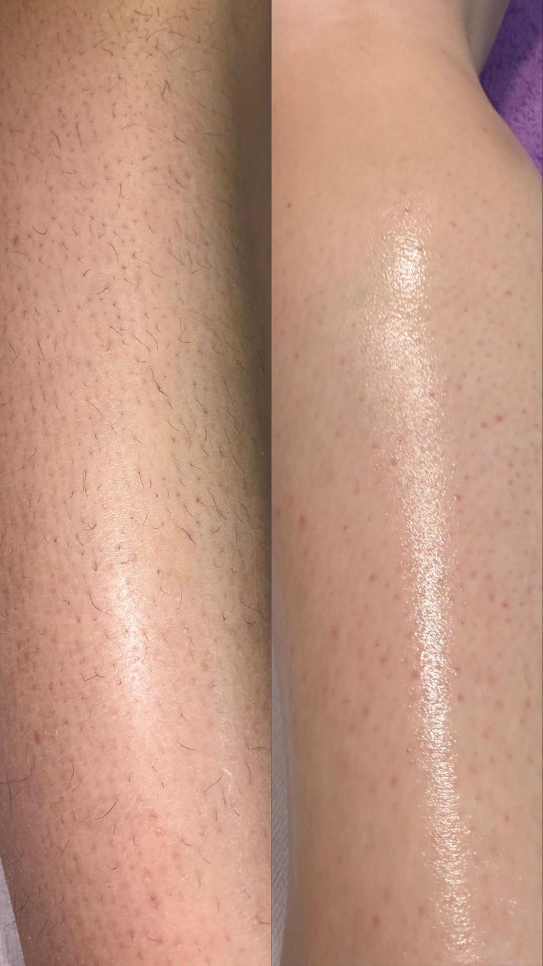 Angels #novisad Depilacija nogu Depilacija pola nogu / ruku /ledja/stomaka toplim voskom - za dame