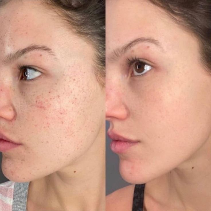 Xenija Beauty Room #beograd Tretman lica Dermapen tretman lica - paket od 4 tretmana + 1 gratis