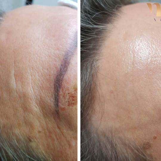 Vila Beauty Studio #beograd Tretman lica Plasma pen (po regiji)