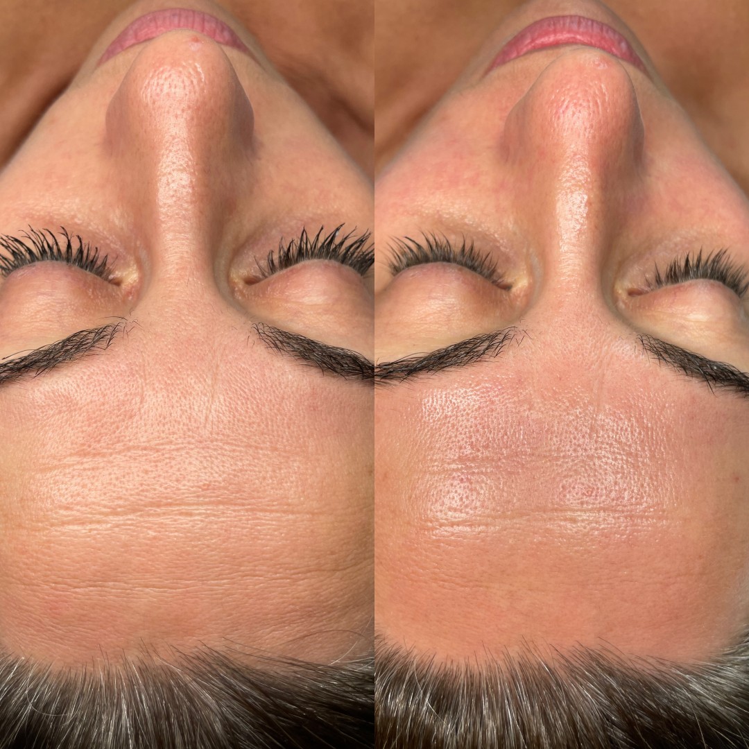 ReNova nutri & beauty #beograd Tretman lica Hidrafacial + oxy jet