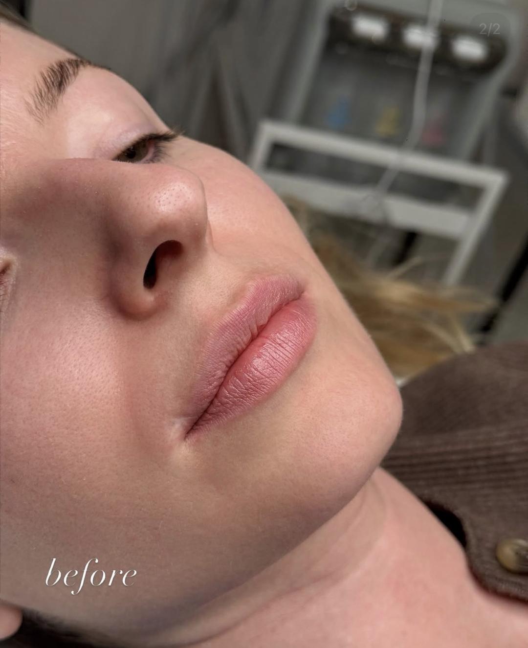 L’Avenue #beograd Mezoterapija lica Hydralips-mezoterapija usana hijaluronom