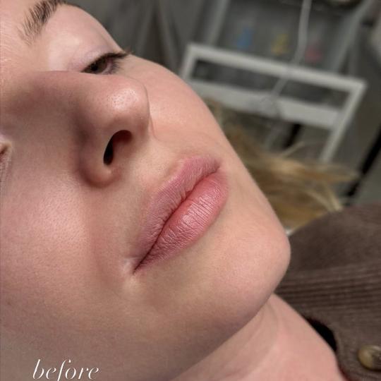 L’Avenue #beograd Mezoterapija lica Hydralips-mezoterapija usana hijaluronom