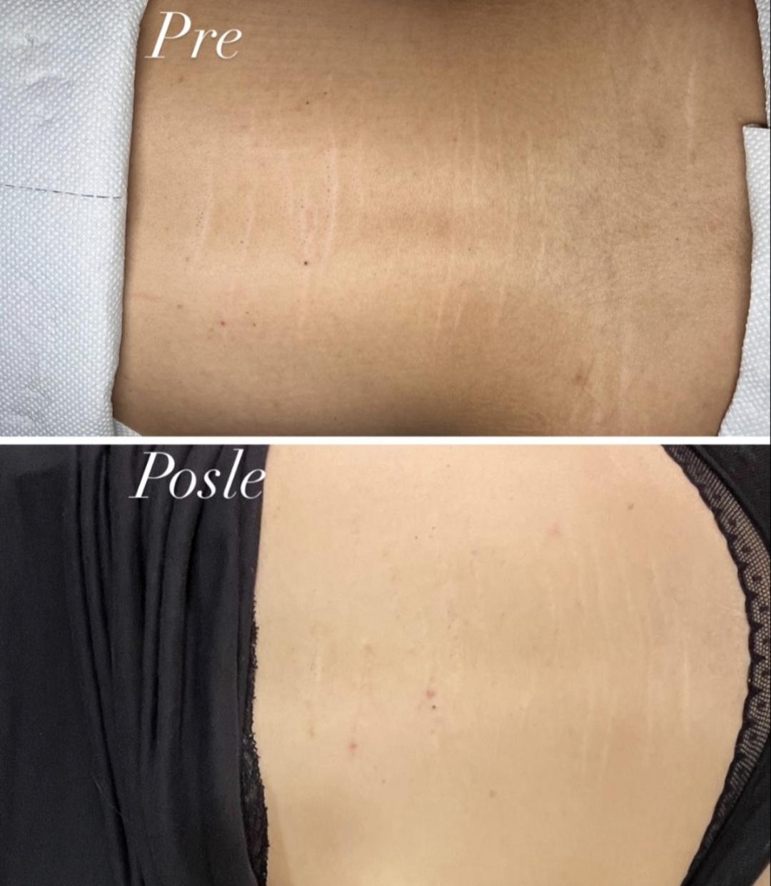 Uklanjanje strija - Beauty queen 011, Beograd Microneedling Lice Microneedling, Beograd, Slavija, Autokomanda, Neimar