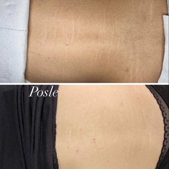 Beauty queen 011 #beograd Microneedling Uklanjanje strija MICRONEEDLING ZA
STRIJE 🍀
• Radi se