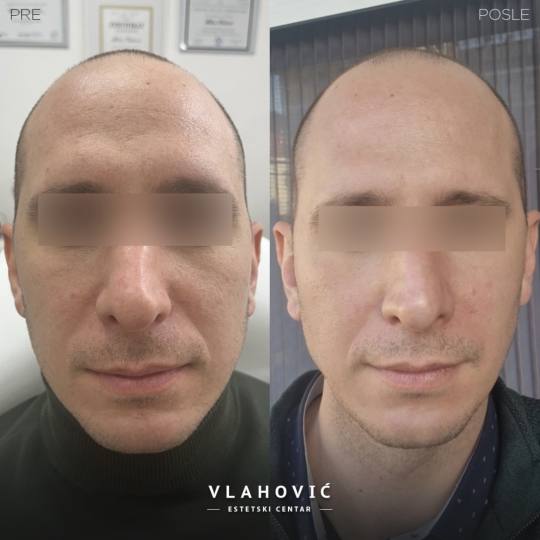 Estetski centar Vlahović #beograd Tretman lica HYDRAFACIAL - regeneracija i rejuvenacija kože HYDR
